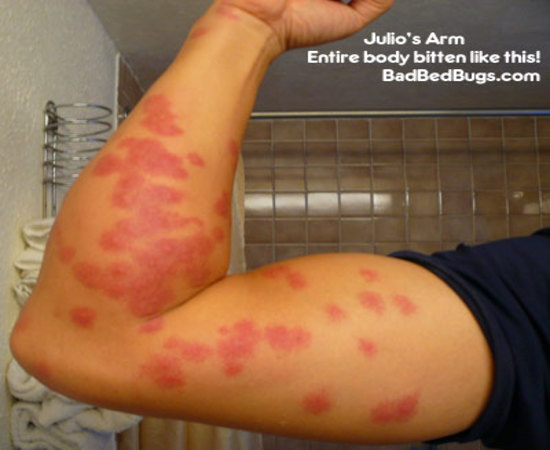 Bed Bug Bites on Black People Skin
