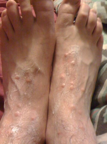 pictures of chigger bites on feet