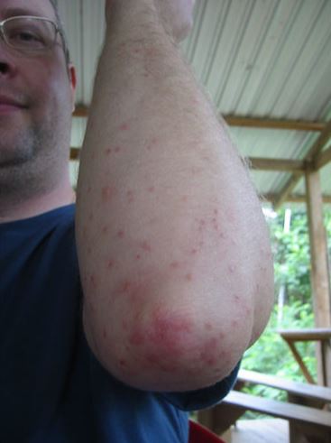 pictures of chigger bites on arms