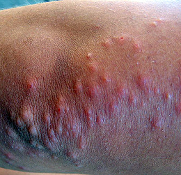 bed bug bites on black skin