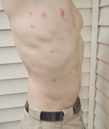 pictures of chigger bites on human skin
