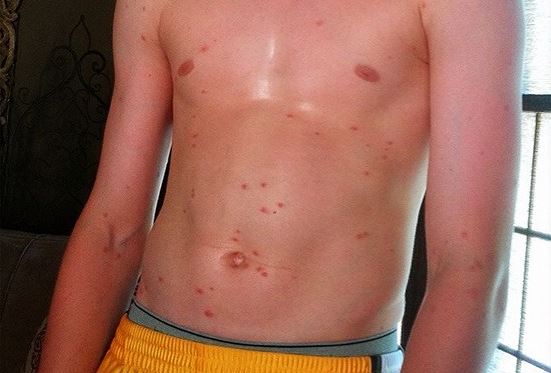Pictures of Chigger Bites on Humans