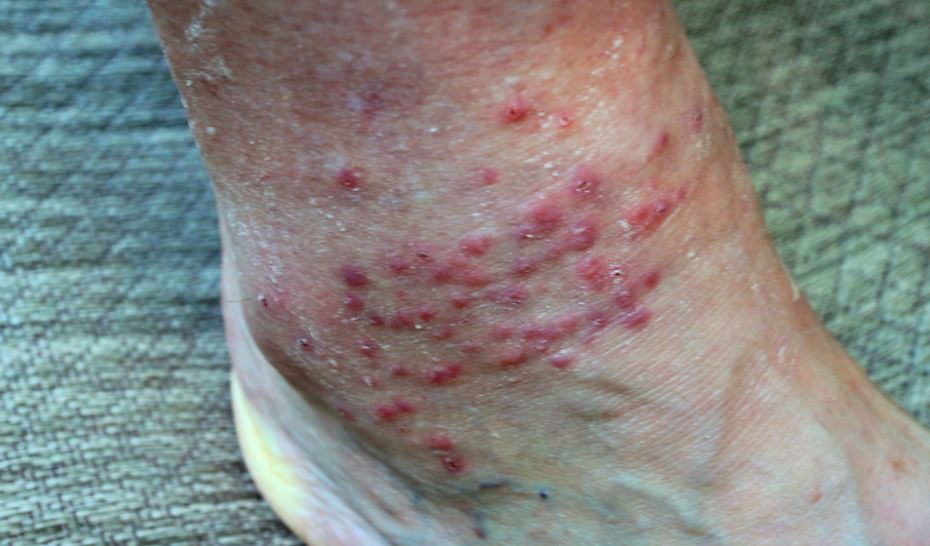 Top 10 Pictures Of Chigger Bites Explained Pest Professional Services