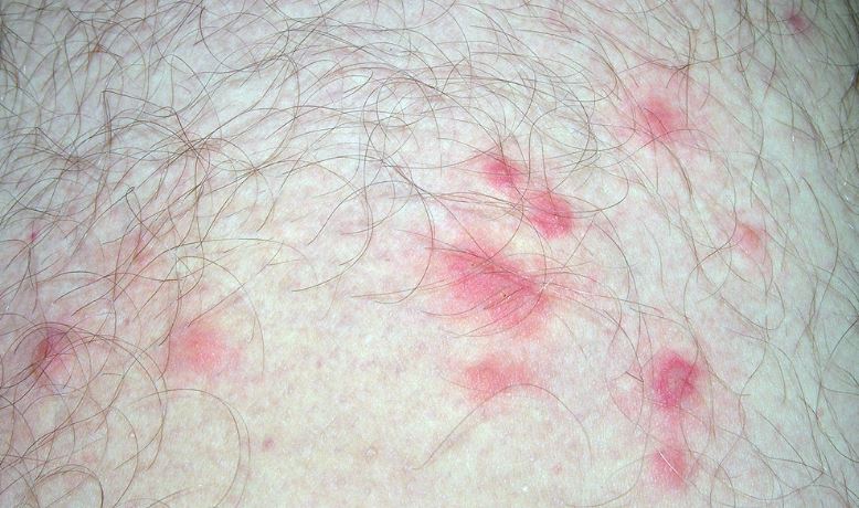 More Chigger Bites Images