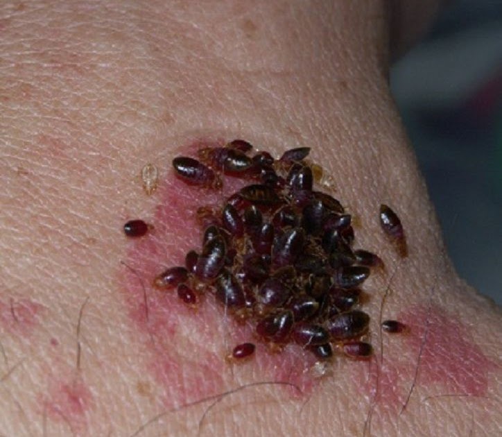 Bed Bug Bites on Black People Skin