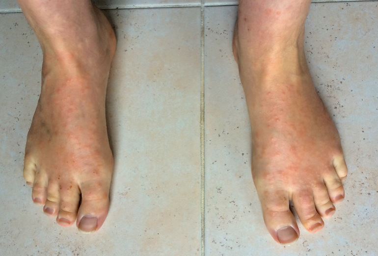 pictures of chigger bites on ankles