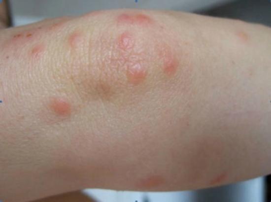 Bed Bugs Bite on Legs