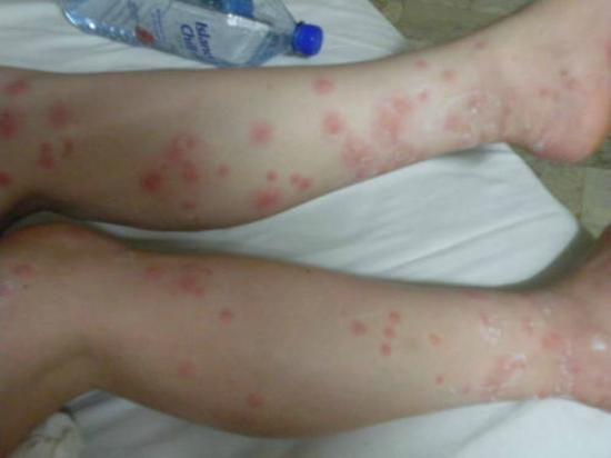 bed bug bites on legs only