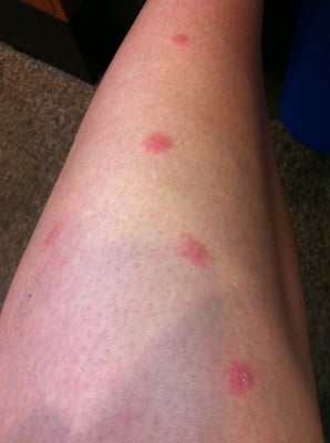 Bed Bugs Bite on Legs