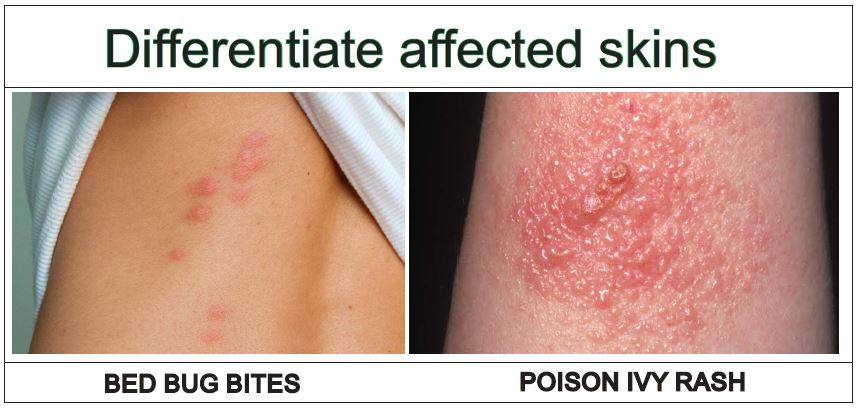 Bed Bug Bite Poison Ivy Rash Vs In 6 Points Explained Y L P C