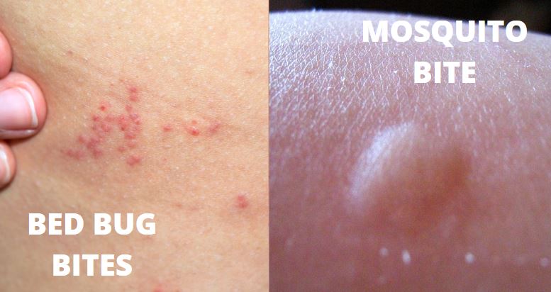 Bed Bug Bite vs Mosquito Bite Pictures