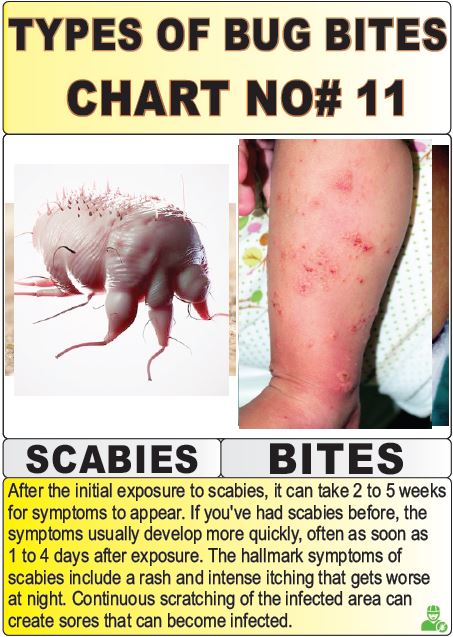 types of bug bites chart