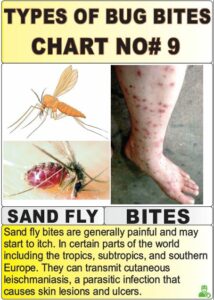 12 Most Harmful Types Of Bug Bites Chart Explained! | Y-L-P-C