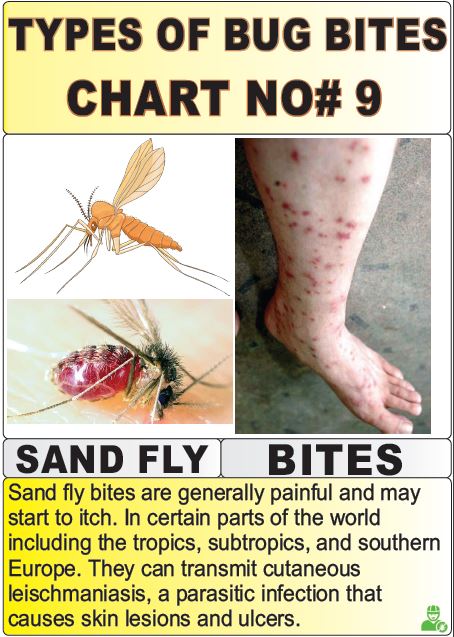 types of bug bites chart