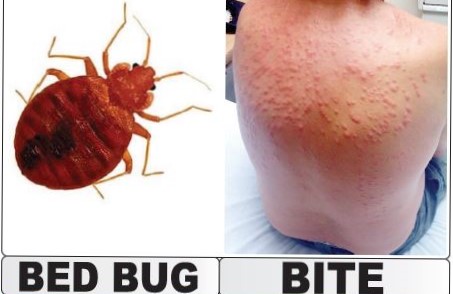 12 Most Harmful Types of Bug Bites Chart Explained!