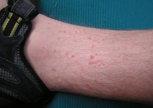 Sand Flea Bites