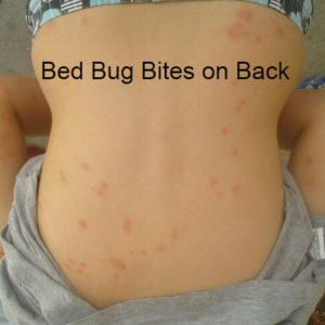 Chigger Bites Vs Bed Bug Bites