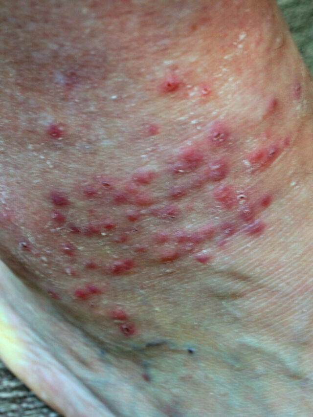 Top 7 Pictures of Chigger Bites