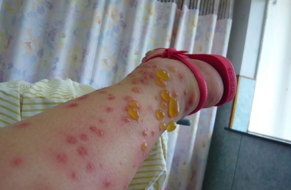 flea-bites-on-humans-pictures-symptoms-and-treatment