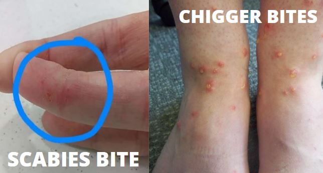 Chigger Bites vs Scabies Bites