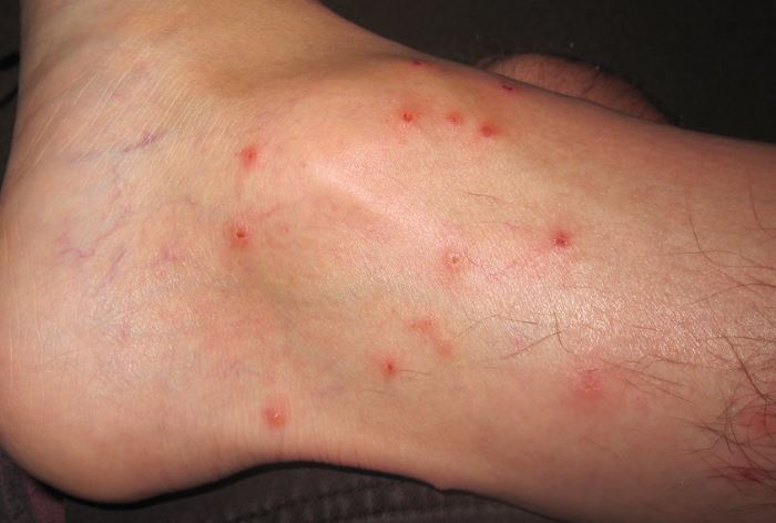 Do Chiggers Burrow in Your Skin?