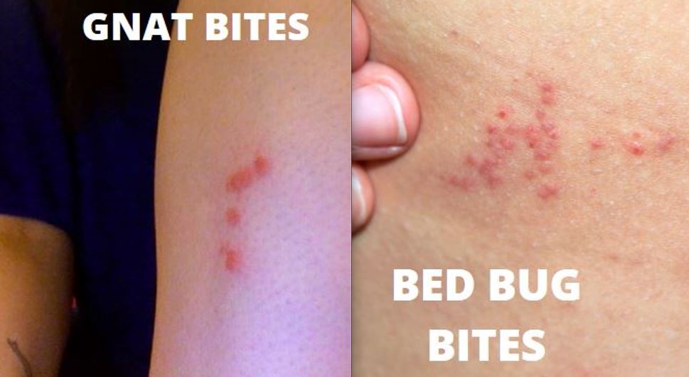 Gnat Bite vs Bed Bug Bite