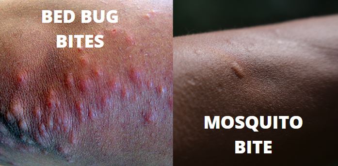 Mosquito Bite vs Bed Bug Bite Pictures